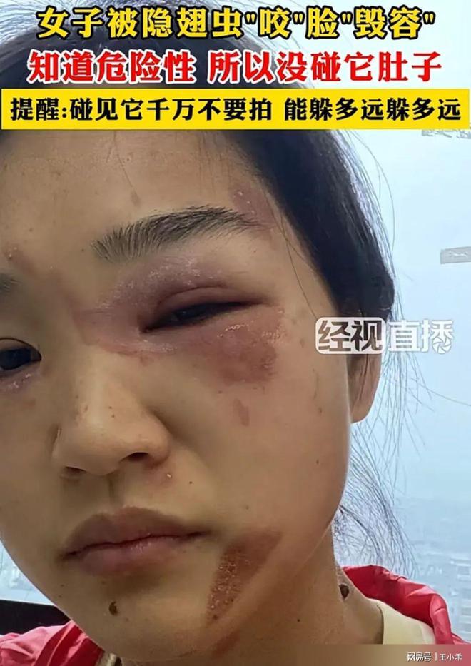 千万别拍！“飞行的硫酸”即将进入活跃期有人中招脖子烂了一圈(图9)
