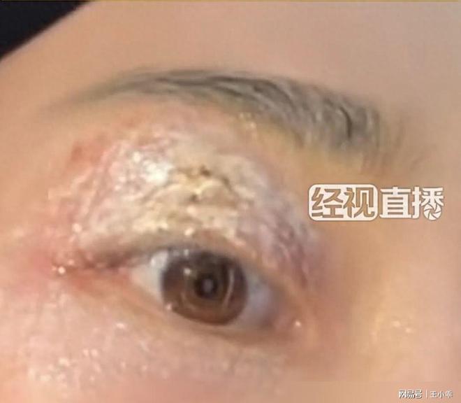 千万别拍！“飞行的硫酸”即将进入活跃期有人中招脖子烂了一圈(图8)