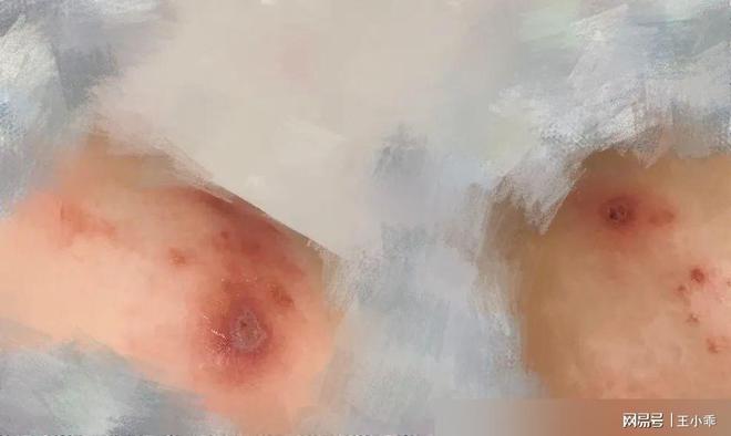 千万别拍！“飞行的硫酸”即将进入活跃期有人中招脖子烂了一圈(图6)