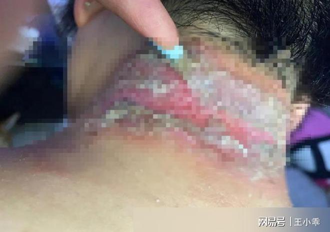 千万别拍！“飞行的硫酸”即将进入活跃期有人中招脖子烂了一圈(图17)
