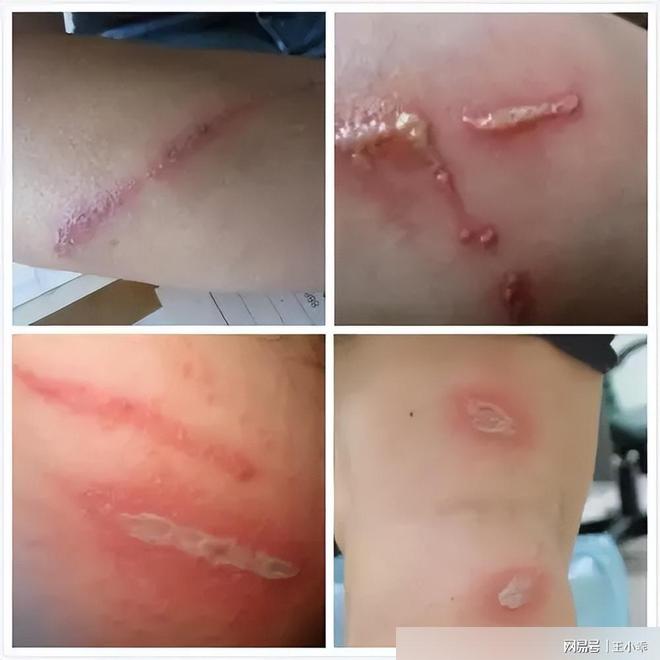 千万别拍！“飞行的硫酸”即将进入活跃期有人中招脖子烂了一圈(图21)