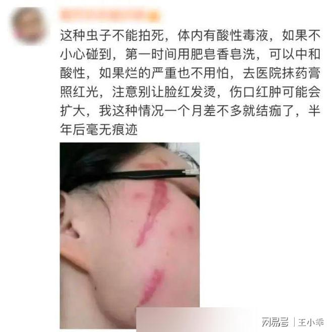 千万别拍！“飞行的硫酸”即将进入活跃期有人中招脖子烂了一圈(图19)