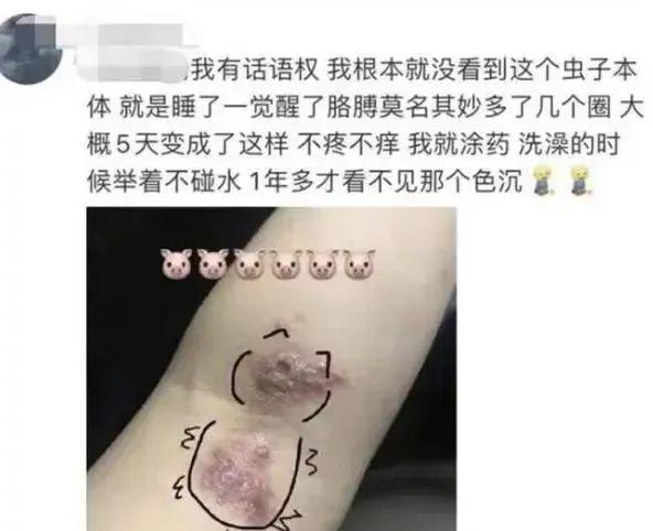 毒液堪比硫酸！合肥已有人中招！隐翅虫！(图3)