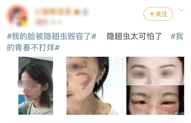 毒液堪比硫酸！合肥已有人中招！隐翅虫！(图1)