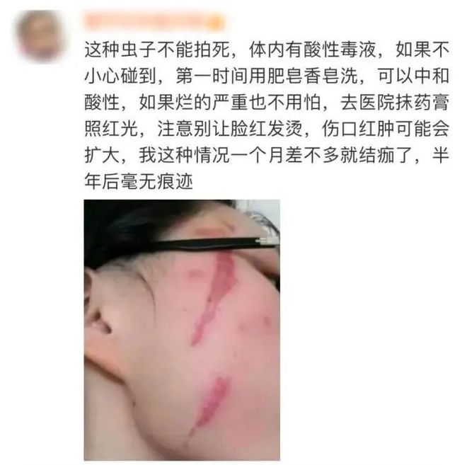 毒液堪比硫酸！合肥已有人中招！隐翅虫！(图2)