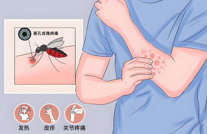 预防基孔肯雅热从防蚊灭蚊开始(图1)